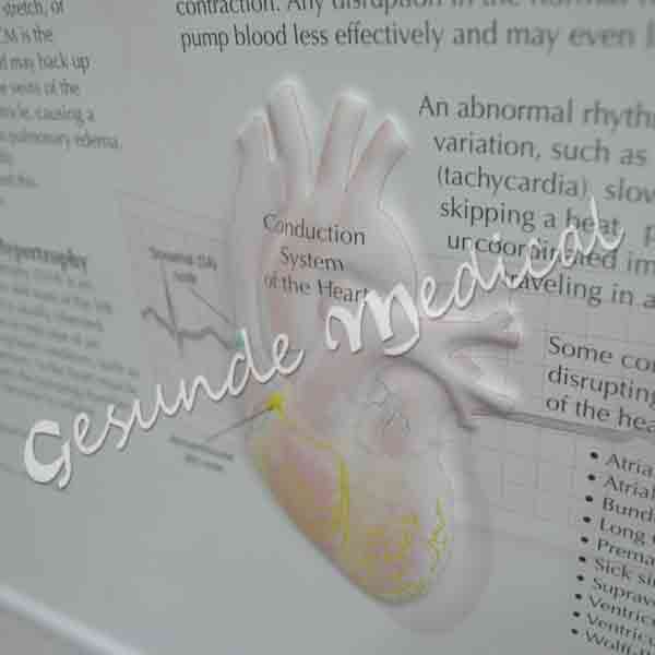 Poster dinding heart disease toko alat pendidikan jual poster anatomi jantung di bintaro